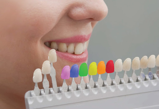 Are Tooth-Coloured Fillings Right For You? Factors To Consider image